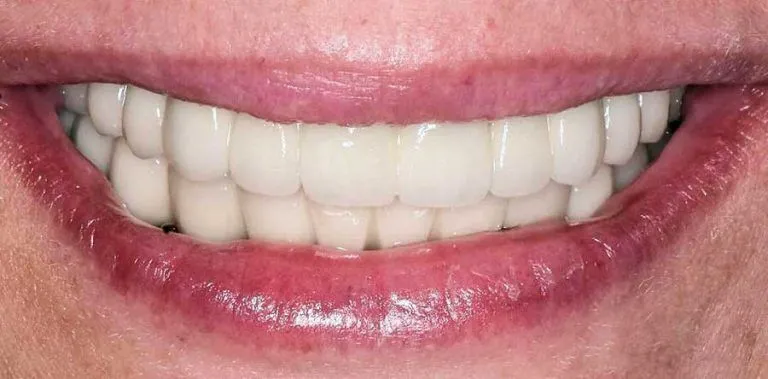 implants-all-on-six-after-768x379