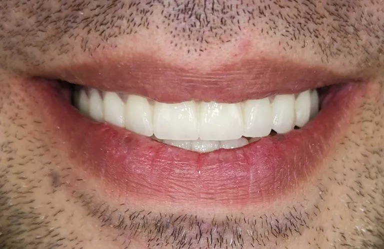 veneers-case04-02-768x499